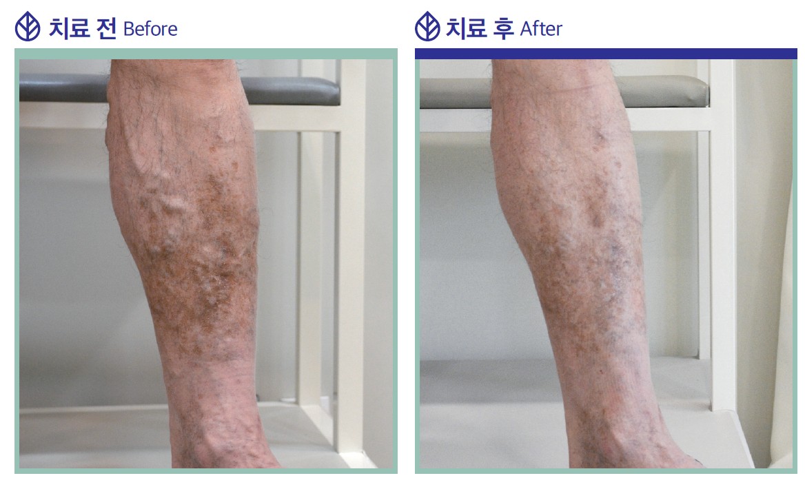 하지정맥류 치료 사례 사진